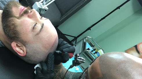Scalp Micropigmentation 8707 Scalp Micropigmentation 8707