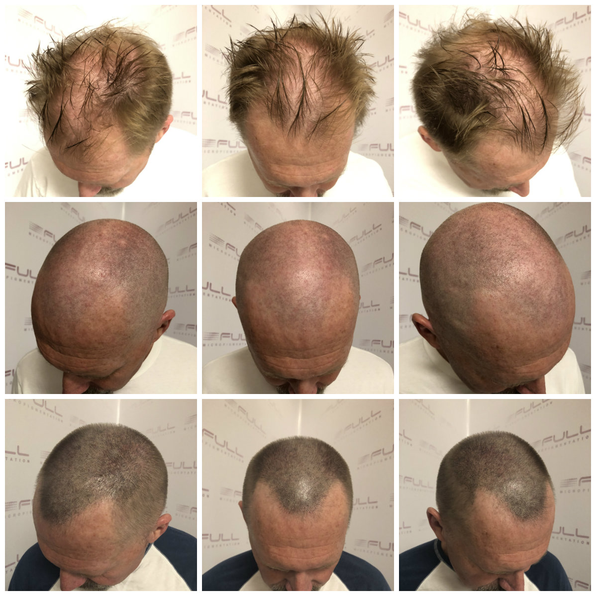 See how SMP transforms thinning hair into a FULL head! FULL