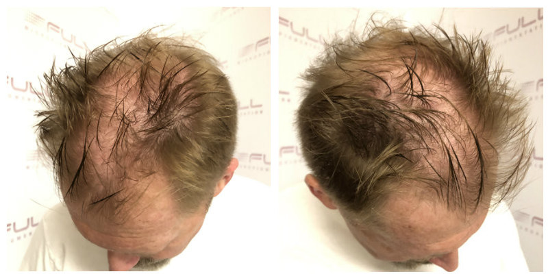 Hover Tid subtraktion See how SMP transforms thinning hair into a FULL head! - FULL  Micropigmentation