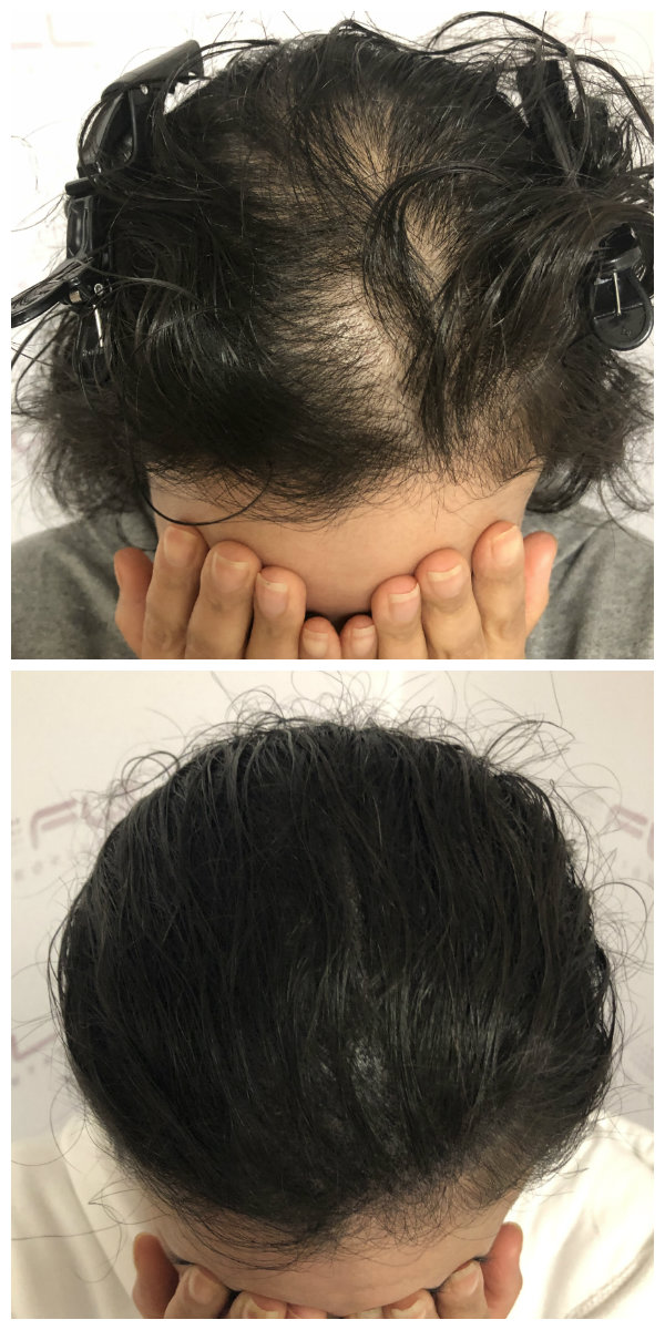 Scalp Micropigmentation For Women Scalp Micropigmentation For Women