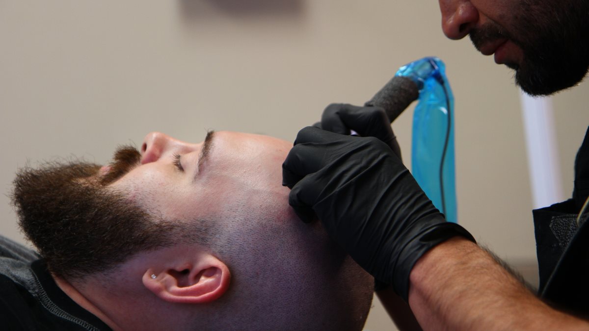 Scalp Micropigmentation for Men in Las Vegas