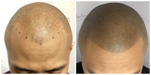 Ronen-New-Before-After-1