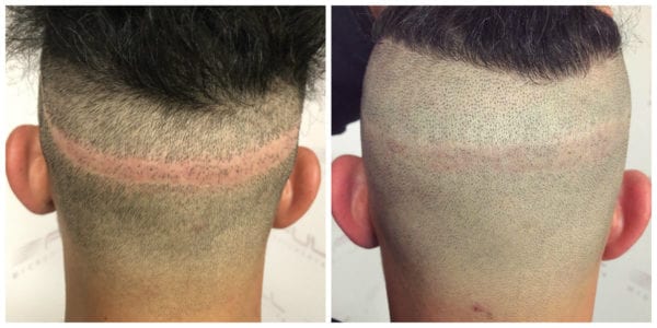 Rony Before After 1