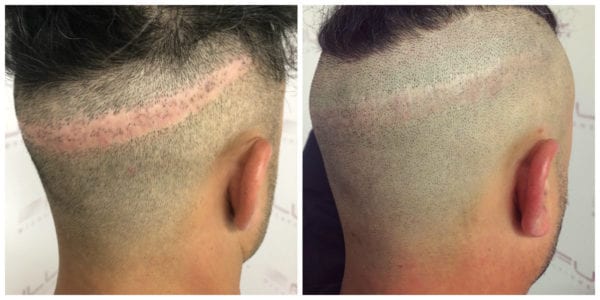 Rony Before After 2