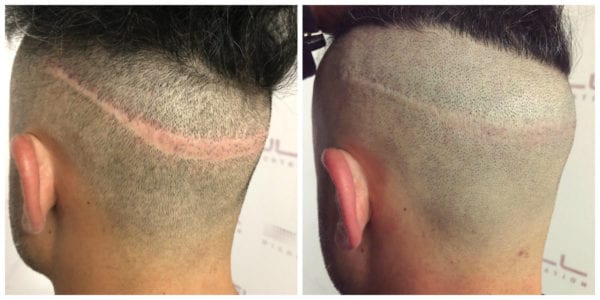 Rony Before After 3