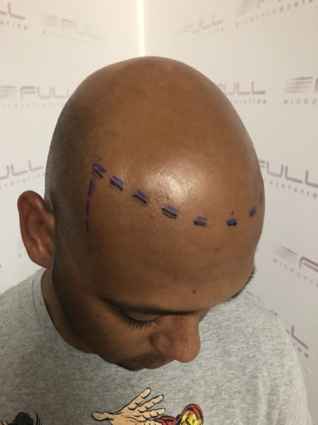 Jay before Scalp micropigmentation Jay before Scalp micropigmentation