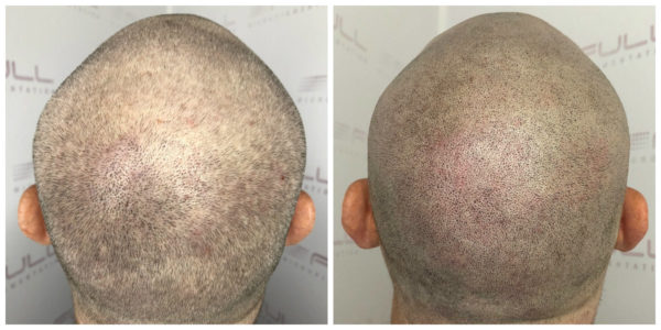 Cal Before After 3