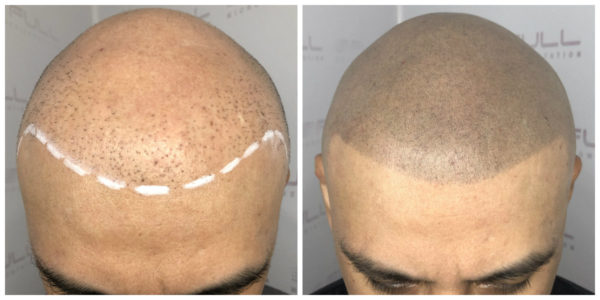 Miguel 2 Before After 1 New