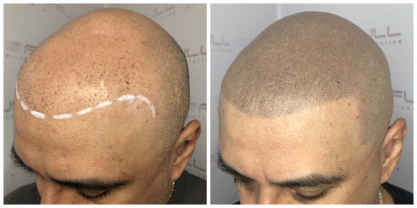 Miguel 2 Before After 2 New