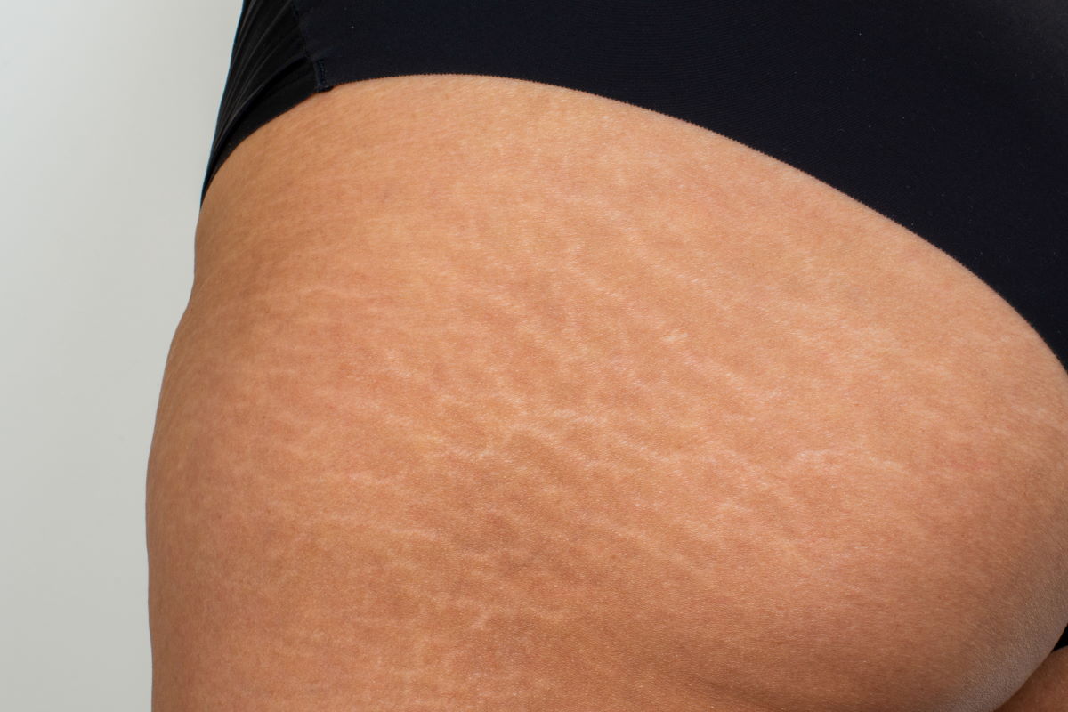 Stretch Mark Camouflage in Las Vegas