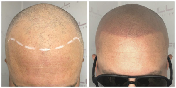Nevan New Before After 1