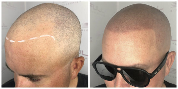 Nevan New Before After 2