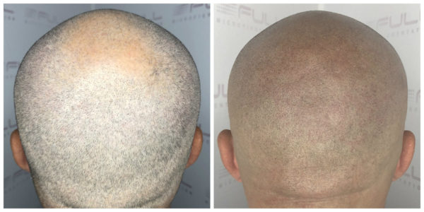 Nevan New Before After 3