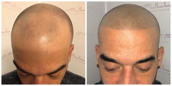 Denny New Before After 1