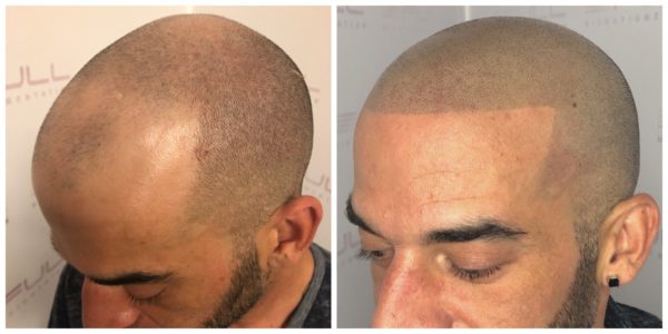 Denny New Before After 2