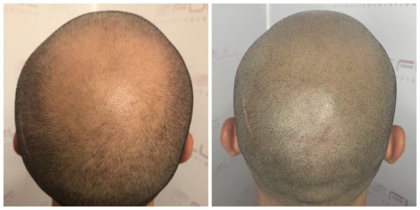 Denny New Before After 3