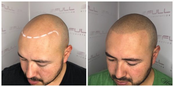 JD before and after 2