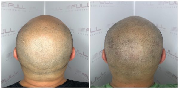 JD before and after 3