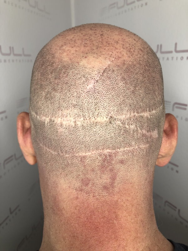 Tom before pics of FUT Scars 1