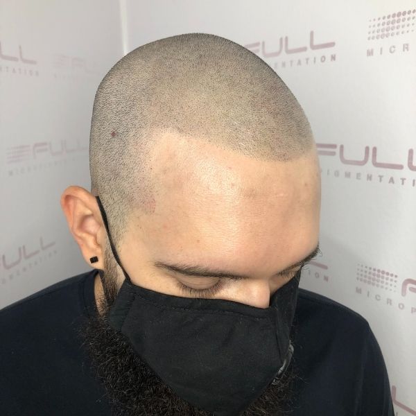 after scalp micropigmentation touch up