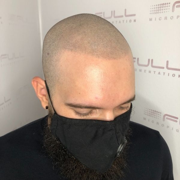 before scalp micropigmentation touch up