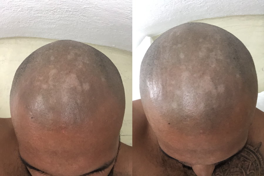 Sunburn Effect on Scalp Micropigmentation