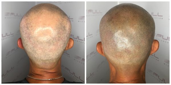 Troy Before After 3