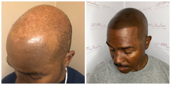Matt Before After Final 2