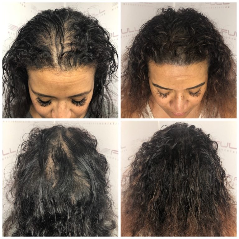 Picture of Thinning Hair Solution - FULL Micropigmentation
