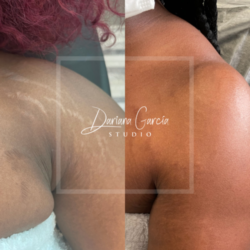 Stretch Mark Camouflage Training in Las Vegas