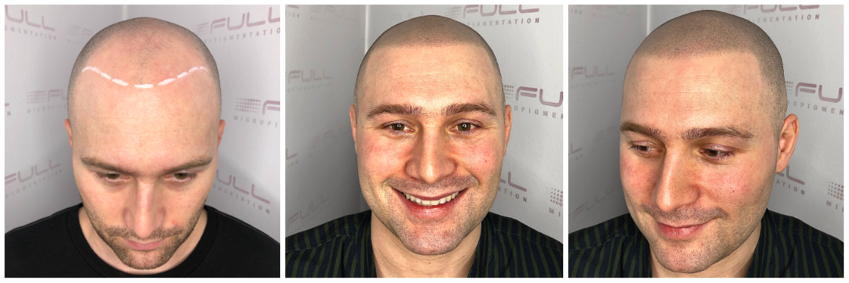 Brandon Healed Results Brandon Healed Results