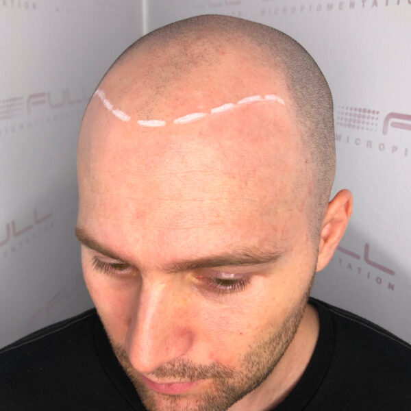 Brandon before Scalp Micropigmentation