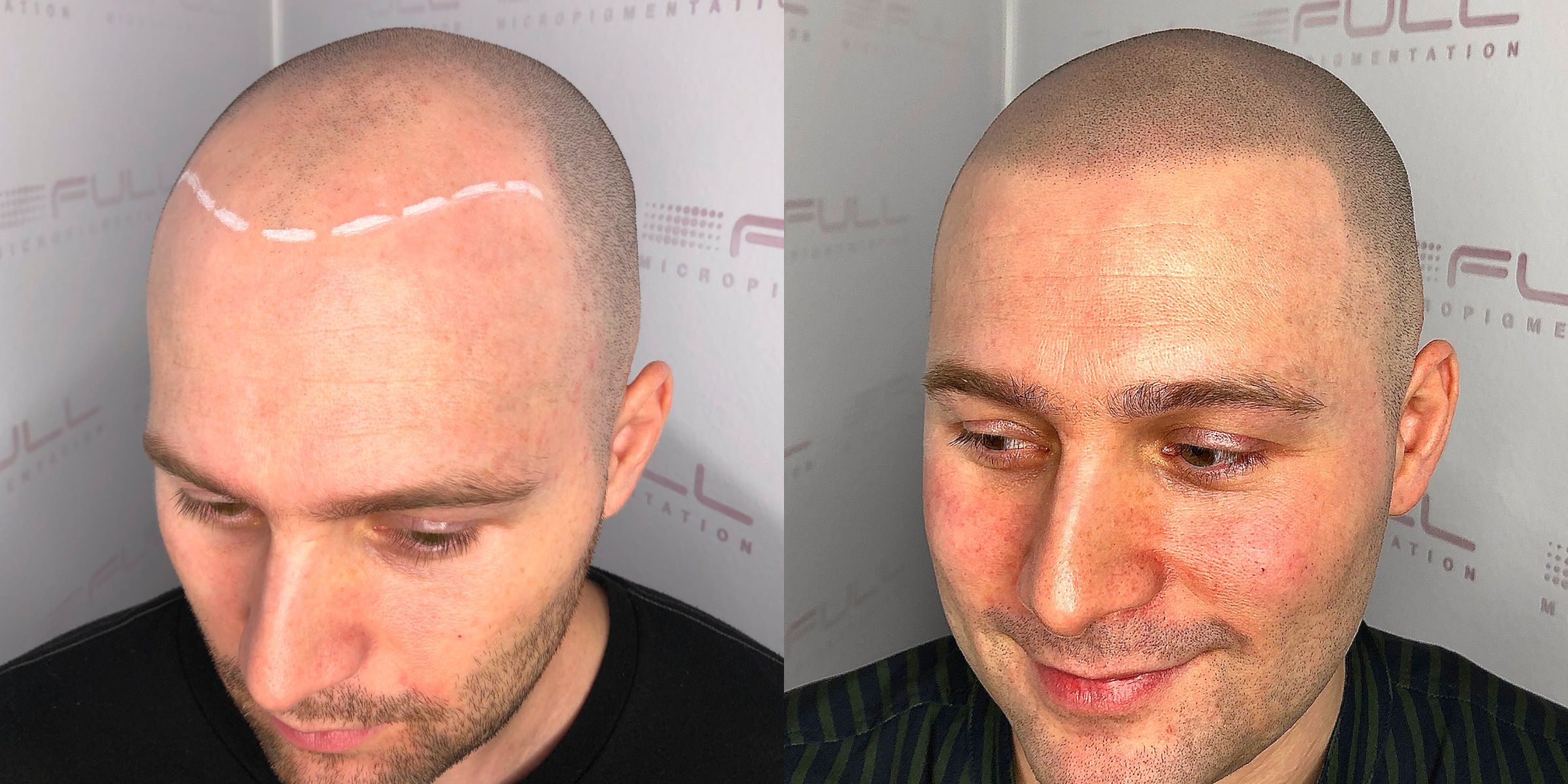 Brandon Before After Scalp Micropigmentation