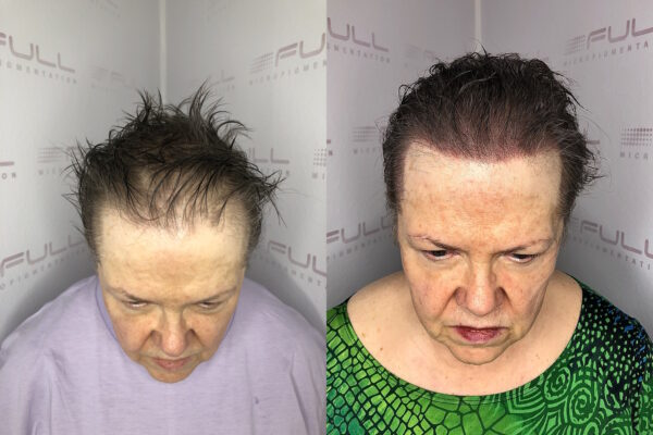 Rani Before After 1