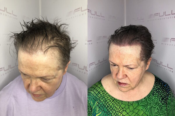 Rani Before After 2
